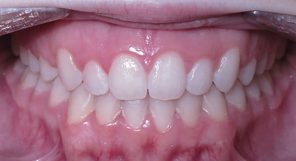 Smile Gallery PDOC After 1-2