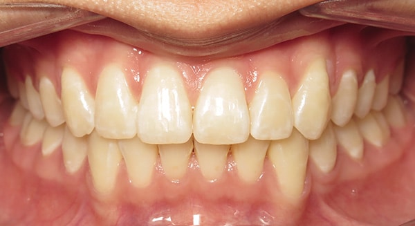 Smile Gallery PDOC After 2