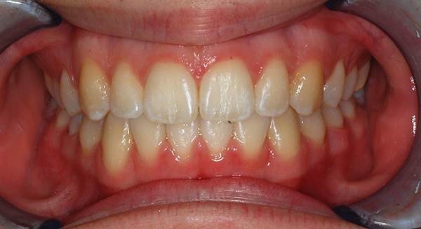 Smile Gallery PDOC After 3-2