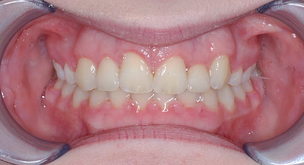 Smile Gallery PDOC After 4