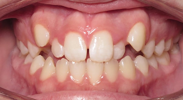 Smile Gallery PDOC Before 1