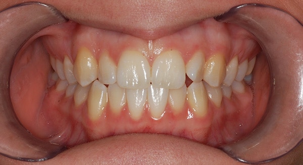 Smile Gallery PDOC Before 3