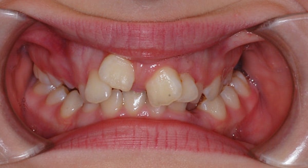 Smile Gallery PDOC Before 4