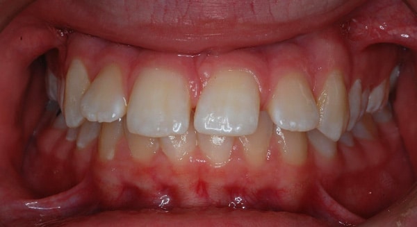 Smile Gallery PDOC Before 5